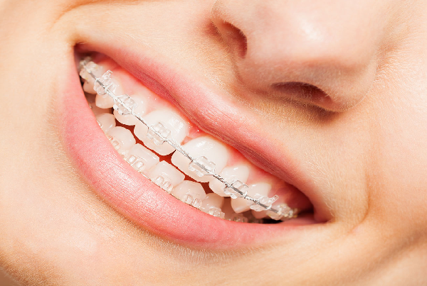 Orthodontic Braces