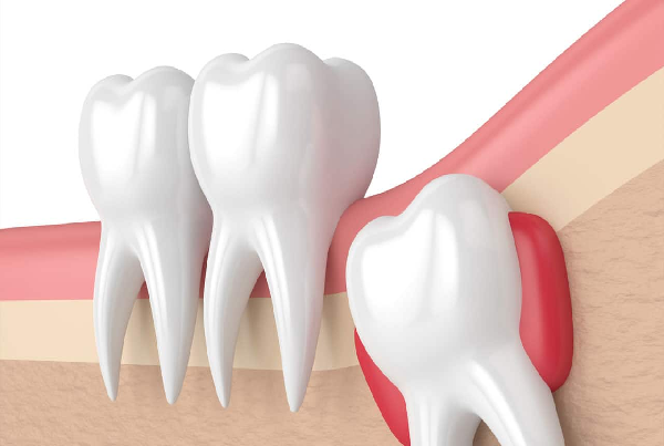 Wisdom Teeth Surgery