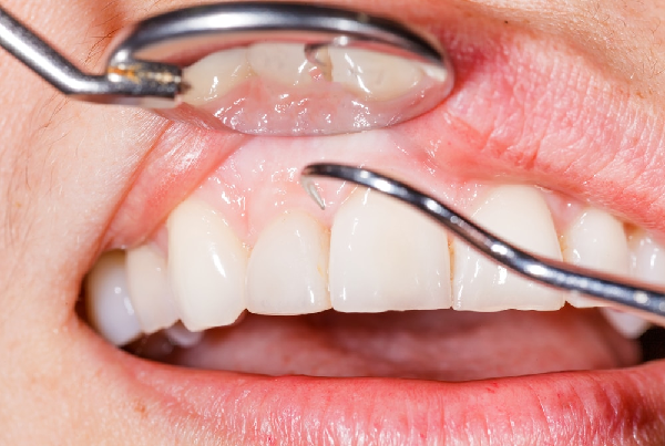 Gum Surgery