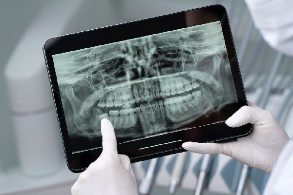 Dental RVG X Ray