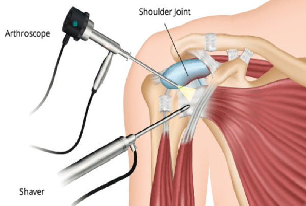 Arthroscopic Surgeries